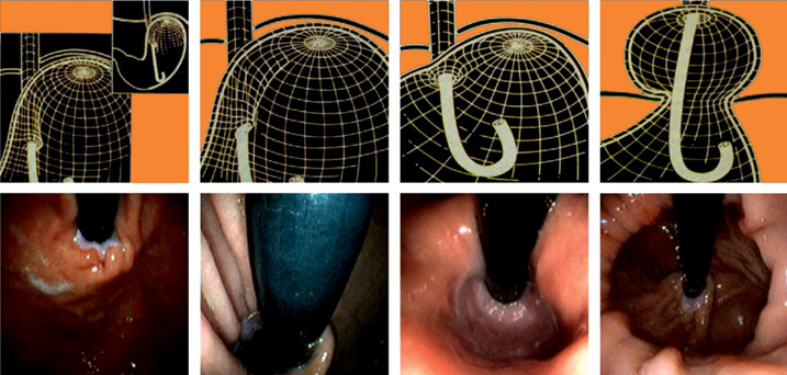 What happens during an endoscopy?