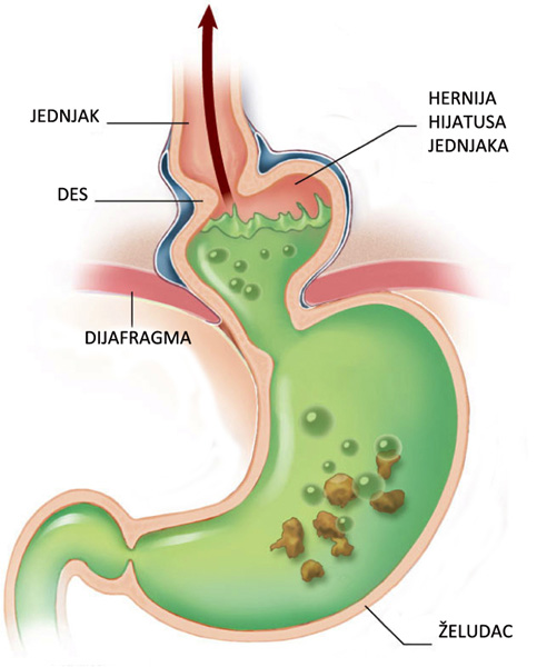 What are ways to alleviate esophagus spasms caused by a hiatal hernia?